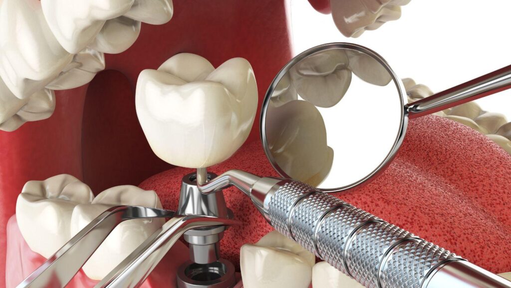 dental implant bone requirements, bone needed for implants, dental implant preparation, implant site bone measurement, implant surgery bone assessment, dental bone graft needs, implant success bone factors, immediate implant bone needs, location-specific dental implants, implant planning bone measurement